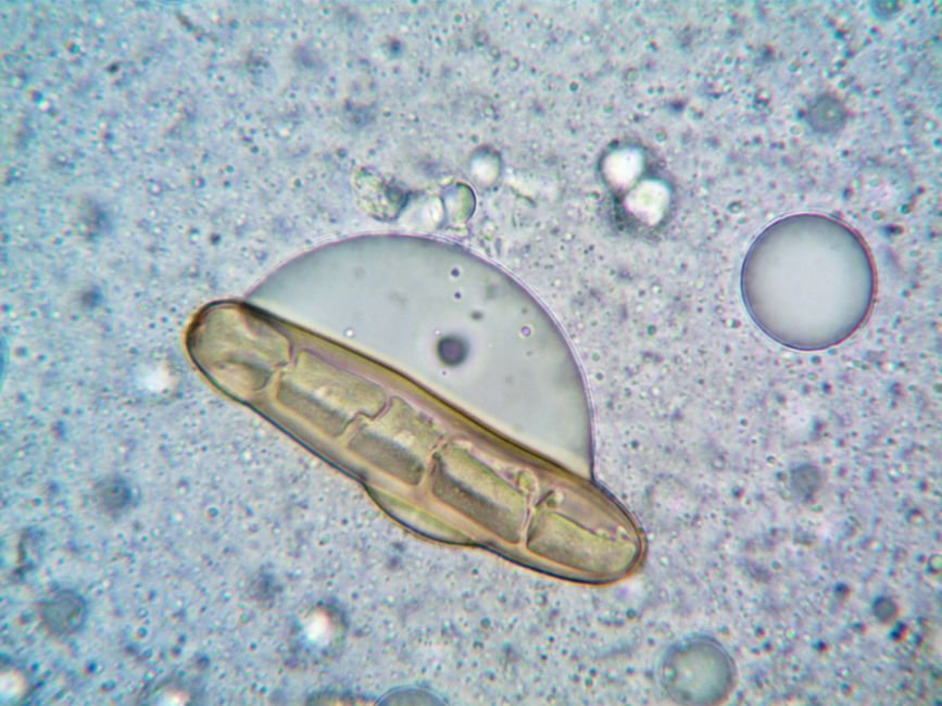 Cyclosporiasis Outbreak Spreads to 31 States, Over 800 Cases Reported
