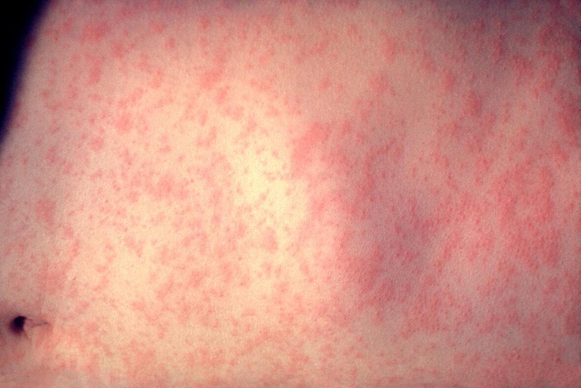 US Measles Cases Surpass 4,000 in 45 States, CDC Reports