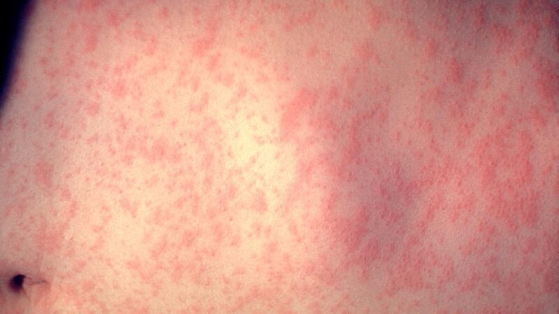 US Measles Cases Surpass 4,000 in 45 States, CDC Reports